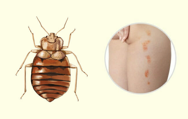 punaises de lit piqure